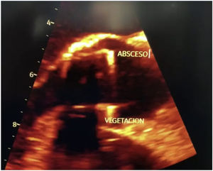 Vegetación y absceso. Posterior, móvil, movimiento independiente, ecogenicidad de tejidos blandos (tamaño: 8×7mm). Anterior, muy móvil ovalada, ecogenicidad de tejidos blandos, diámetro: 15×6mm, bordes irregulares.