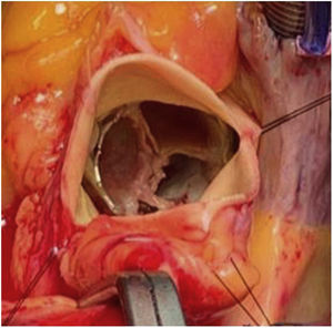 Válvula biológica Edwards n.o 23 implantada por TAVI con daños estructurales por vegetaciones en sus valvas.