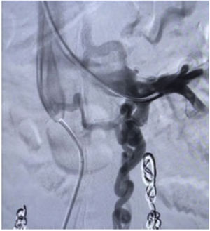 Surgical technique, dilated left gonadal vein.