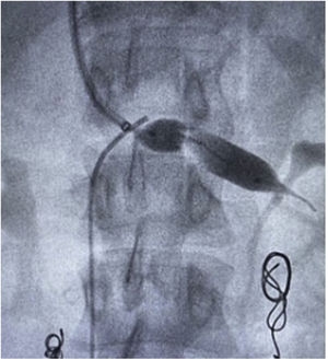 Surgical technique, balloon LRV angioplasty.