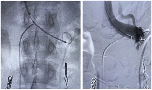 Surgical technique, deployment of a e-Luminex self-expanding nitinol bare metal arterial stent (10–12mm×40mm).