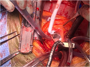 Crioablación del velo coronario derecho sobre la cara ventricular, tras resección del fibroelastoma papilar.