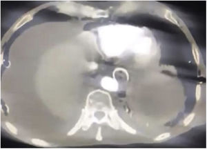 AngioCT: CT shows direct contact of the esophageal self-expandable partially covered metal stent with the aortic wall generating the aortoesophageal fistula.