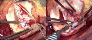 VAB fusionada con rafe. Imagen intraoperatoria en la que se observa un rafe en el velo fusionado (flecha) de esta VAB que condiciona restricción del velo. Se realiza un shaving y decalcificación del velo para ganar movilidad.