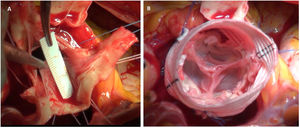 Síndrome de Marfan y reimplante. En la figura 4A se muestra la elasticidad del velo aórtico en un anillo dilatado. Tras fruncir el anillo aórtico con el graft, se observa cómo la coaptación de la válvula es perfecta sin necesidad de procedimientos sobre la válvula (fig. 4B).