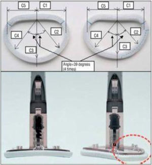 Comparación entre el anillo clásico Physio® (izquierda) y el anillo CMA IMR ETlogix® (derecha). Este último está infradimensionado, con un 14% de reducción en el eje posteromedial (dimensión C1, C2). Además, presenta una depresión a nivel de P2-P3 mitral y un menor tamaño a nivel de P2-P3 (dimensión C1, C2). Cortesía de Edwards Lifesciences. Reproducido con permiso de Mosquera et al.4.