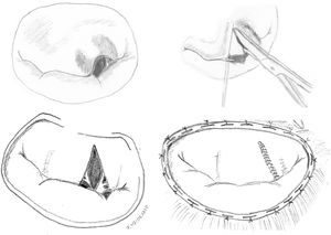 Resección triangular de velo anterior.