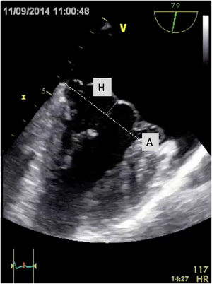 Medición ecocardiográfica de la longitud de las cuerdas tendinosas. A, línea anular; H, cuantificación de la elongación de la cuerda.