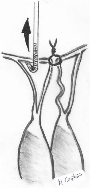 Determinación de longitud de la neocuerda mediante punto borde-con-borde («edge-to-edge») y tracción con gancho de nervios.