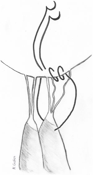 Implante de neocuerdas mediante sutura continua y referencia anular.