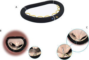 Anillo semirígido Memo 3 D Rechord (LivaNova PLC, Londres, Reino Unido). A: anillo de anuloplastia; B: pase de la neocuerda por las guías; C: anudado de la neocuerda a nivel anular.