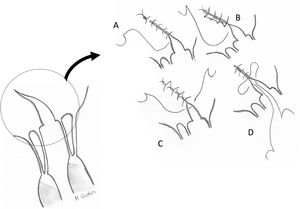Tipos de sutura de velo mitral. A: continua; B: continua bloqueada; C: puntos sueltos evertidos; D: puntos sueltos invertidos (el nudo se orienta hacia la cara ventricular del velo).