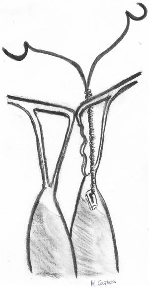 Técnica de anudado subvalvular de músculo a velo para medición de longitud de neocuerdas con efecto anti-deslizante.