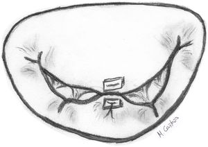 Sutura borde-con-borde («edge-to-edge» o «punto de Alfieri»).