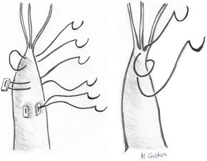 Técnicas de fijación de las cuerdas de Gore-tex® en el músculo papilar. A: punto en U sin parche; B: punto en U con parche; C: punto en U anudado con parches; D: punto en 8 («figure of eight»).