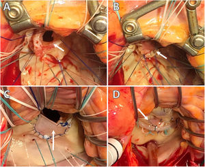 Endocarditis infecciosa. Imágenes intraoperatorias. Servicio de Cirugía Cardiovascular del HU Virgen de las Nieves. A) Resección de tejido infectado de A2 con preservación del borde libre y cuerdas de primer orden normofuncionantes. B) Reconstrucción de la solución de continuidad postexéresis de velo anterior mediante interposición de parche de pericardio bovino. C) Reconstrucción de velo posterior, tras exéresis de tejido infectado de P2, mediante interposición de parche de pericardio bovino (detalle de sutura continua bloqueada polipropilene 5/0. D) «Water-test» tras la reconstrucción valvular e interposición de neocuerdas de Goretex 4/0 en el borde libre de neovelo.