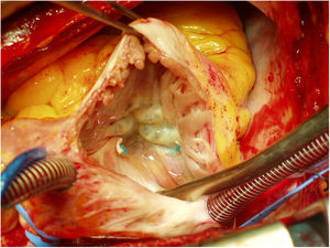 Anuloplastia de De Vega. Obsérvese cómo la sutura se superpone claramente con la comisura antero-posterior.