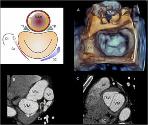 Relaciones del anillo mitral. Reconstrucciones con (A) ETE 3D, (B) CardioTC a nivel de base ventricular y (C) CardioTC a nivel de seno coronario.AP: arteria pulmonar; Cx: arteria circunfleja; OI: orejuela izquierda; SC: seno coronario; TD: trígono derecho y haz de His; TI: trígono izquierdo; TSVI: tracto de salida del ventrículo izquierdo; VAo: válvula aórtica; VM: válvula mitral; VP: válvula pulmonar.
