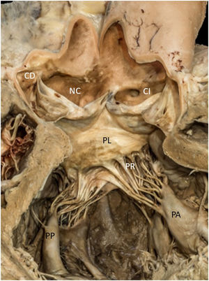 Imagen anatómica del tracto de salida ventricular izquierdo.CD: ostium coronario derecho; CI: seno coronario y ostium izquierdo; NC: seno no coronariano; PA: músculos papilares anteriores; PL: velo anterior porción lisa; PP: músculos papilares posteriores; PR: velo anterior porción rugosa. (Imagen cedida por la Faculat de Medicina, área de Anatomia y Embriologia Humana, Universitat de les Illes Balears [UIB].)