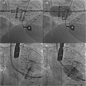 Imagen de la prótesis Sapien 3 crimpada en posición coplanar a la bioprótesis mitral degenerada (1A). Inflado del balón (1B). Imagen de la prótesis Sapien 3 crimpada en posición coplanar a la prótesis tricúspide degenerada (1C). Inflado del balón en tricúspide (1D).