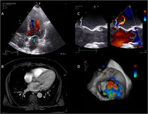 Imagen multimodal en insuficiencia mitral funcional. (A) Eje largo apical ETT. (B) Corte axial de perfusión basal LAVA en cardioRM. (C) ETE 2D 120°. (D) Reconstrucción ETE 3D.