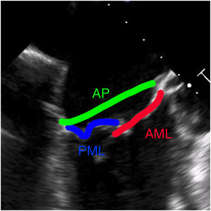Índice velo-anillo (Leaflet-to-annulus index,[LAI]), estimado mediante la suma de la longitud del velo anterior mitral (AML) y velo posterior mitral (PML), sobre el diámetro anteroposterior del anillo mitral (AP), medidos en el eje largo durante la mesosístole.