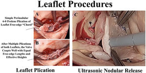 Panel A – A prolapsing Type 0 bicuspid valve is undergoing free-edge plication with simple 6-0 Prolene sutures, passed into the leaflet free-edge chord. Panel B – Shortening of the free-edge raises the leaflet and corrects the prolapse. Panel C – A scarred retracted Nodulus Arantius is thinned with the ultrasonic aspirator to improve Nodular suppleness and central leaflet coaptation.