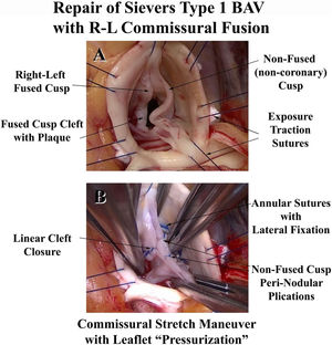 Features in the repair of a Type 1 right-left commissural fusion bicuspid valve. Panel A shows the right-left commissural fusion cleft along with a prolapsing non-coronary cusp. Panel B illustrates the repair features with annuloplasty ring insertion, non-fused leaflet plication, and linear cleft closure. The leaflets now have equal free-edge lengths and coaptation heights.