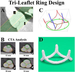 Panel A – High-resolution CT angiograms were obtained in 11 awake patients with normal aortic valves undergoing coronary screening. One millimeter transverse cuts were made from the left ventricular outflow tract to above the sino-tubular junction. Panel B – At each vertical level, high density data points defined each of the root structures, coded for the various leaflets and sinuses. Panel C – Using three-dimensional least squares regression and general ellipsoidal models, the average three-dimensional coordinates for the leaflet-aortic junction (red) were defined, thus obtaining for the first time the geometry of the aortic valve annulus fibrosus. Panel D – From these data, a computerized machining device milled annuloplasty rings with similar geometry from solid blocks of Titanium, covered with a thin layer of polyester to promote endothelialization. HAART 300 ring, BioStable Science and Engineering Inc., Austin, TX.