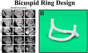 Panel A – CT angiograms were obtained in patients undergoing successful bicuspid valve repair using sub-commissural annuloplasty and Schaefers’ leaflet reconstruction. The center column shows a variety of preoperative configurations from a patient with Type 1 right-left leaflet fusion and three equal sinuses (Patient 4) – to a Type 0 bicuspid valve with equal fused and non-fused sinuses (Patient 5). In all patients, the bicuspid valve was elliptical with the long axis being the sinus-to-sinus diameter. In all geometries, successful repair was observed to create more of a circular base geometry (pink circles) with approximately 180° commissures (red triangles). Panel B – The sub-commissural post geometry was borrowed from the tri-leaflet ring, and the circular base geometry with 180° commissural posts was machined from solid blocks of Titanium and covered with a layer of polyester to promote endothelialization. HAART 200 ring, BioStable Science and Engineering Inc., Austin, TX.