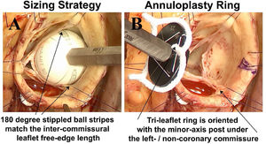 Panel A – Leaflet free-edge length (FEL) is measured from commissure to commissure using special ball sizers positioned in the sinus. FEL/1.5 determines the ring diameter required for valve competence. Panel B – The elliptical tri-leaflet ring is positioned so the minor axis post is posterior – beneath the left/non-coronary commissure, and the right coronary leaflet is opposite on the broad anterior annulus.