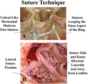 Panel A – The ring posts are first sutured beneath the sub-commissural triangles using Cabrol-like horizontal mattress sutures, and the device is lowered below the valve. Then, trans-annular horizontal mattress looping sutures fix the ring under the annulus, taking care to leave no gaps or loose sutures. Panel B – After repair, the lateral fixation sutures are evident to direct suture tails laterally away from the leaflets. With low positioning of the ring posts low in the sub-commissural triangle, the leaflets become more vertical, augmenting leaflet coaptation height.