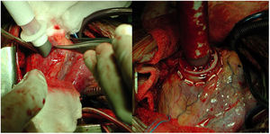 Localización del punto de inserción de la cánula a nivel del ápex del ventrículo izquierdo (imagen de la izquierda). Implante de la cánula a nivel del ápex sobre puntos apoyados en pledgets de teflón.