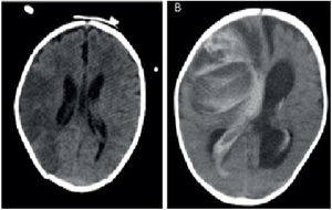 Hallazgos radiológicos compatibles con ictus: isquémico a nivel del núcleo lenticular izquierdo (imagen de la izquierda), hemorrágico a nivel de fosa posterior (imagen de la derecha).