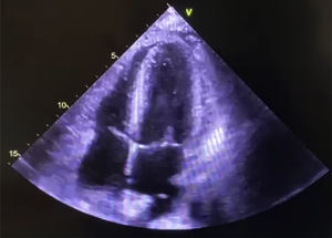 Imagen ecocardiográfica que muestra el defecto septal interventricular residual.