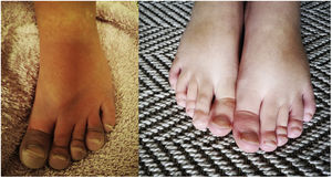A) Episodios de cianosis distal. B) Resolución de la clínica tras el tratamiento.