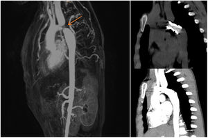 A) Angio-RM toracoabdominal: se observa coartación aórtica grave. B) Angio-TAC torácica tras angioplastia en la que se observa stent aórtico permeable.