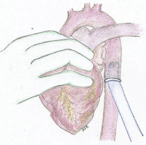 Berlin Heart ® aortic cannula, 9mm and 60̊, suturing a 12mm Dacron tube to the end and subsequently suturing it to the descending thoracic aorta at the retrocardiac level.