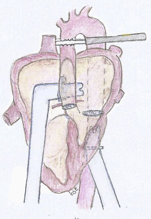 Berlin Heart® 9mm atrial cannula with 23mm tip, through the interatrial septum, reinforcing the suture in the septum with a pericardial patch, and, at the exit of the heart cannula, through the right atriotomy.
