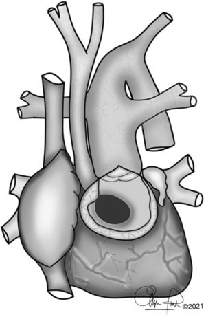 Interrupted aortic arch type B associated with aortic stenosis and non-restrictive ventricular septal defect.