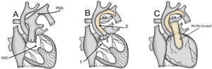 (A) Interrupted aortic arch type B associated with aortic stenosis and non-restrictive ventricular septal defect. VSD: ventricular septal defect; PDA: Patent ductus arteriosus. (B) 1: Redirection of left ventricle outflow through the ventricular septal defect to both semilunar valves (Damus–Kaye–Stansel anastomosis); 2: Aortic arch reconstruction. (C) Establishment of right ventricle – pulmonary artery continuity using a valved conduit. RV-PA: right ventricle-pulmonary artery.