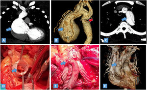 Caso 1. A y B) Angiotomografía mostrando el aneurisma de la aorta ascendente (flecha azul) y la coartación de la aorta (flecha roja) C) Se muestra el trazo de disección del arco aórtico (flecha azul) y el tronco braquiocefálico (flecha blanca). D) Imagen de la cirugía mostrando la válvula aórtica implantada dentro del tubo de dacrón. E) Reemplazo del arco aórtico y derivaciones a los troncos supraaórticos. F) Control tomográfico a los 6meses mostrando los injertos colocados (flecha azul).