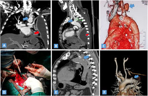 Caso 2. A-C) Angiotomografía mostrando la úlcera aórtica complicada con seudoaneurisma (flecha azul), además hemotórax masivo (flecha roja). D) Cirugía por toracotomía axilar. E y F) Control tomográfico mostrado la ausencia de la úlcera y el pseudoaneurisma (flecha azul).