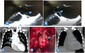 Caso 3. A) Ecografía transesofágica intraoperatoria, vista en 1100, en sístole, mostrando el trazo de disección en la aorta ascendente (flecha azul). B) En diástole la disección prolapsa dentro del tracto de salida del ventrículo izquierdo (flecha azul). C) Angiotomografía mostrando dilatación de la aorta ascendente. D) Foto del resultado de la cirugía luego de reemplazar la aorta ascendente y el arco aórtico, y mostrando las derivaciones a los vasos supraaórticos (flecha azul). E) Control tomográfico a los 6meses mostrando el injerto colocado (flecha).