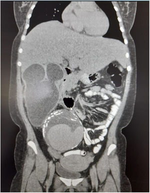 En un corte coronal se observa el aneurisma gigante que comprime el riñón y parte del hígado. Fuente: elaboración propia.