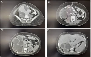 En un corte transversal se muestra un aneurisma gigante que afecta estructuras adyacentes como el hígado y la hidronefrosis del riñón.