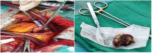 Foto intraoperatoria en el momento de la resección de la masa (trombo) de la aurícula derecha.