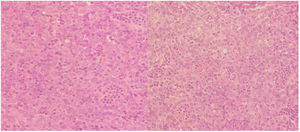 Biopsia de la adenopatía mediastinal. Microtinción hematoxilina y eosina. Se observa metástasis difusa de células epiteliales malignas largas de aspecto epitelioide, que altera la arquitectura normal del ganglio con dispersas células inflamatorias que infiltran las células malignas.