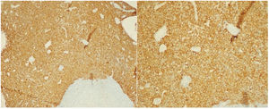 Biopsia de la adenopatía mediastinal. La inmunohistoquímica del anticuerpo anti-pan-citoqueratina presentó un difuso y fuerte marcaje de las células malignas, indicando carcinoma.