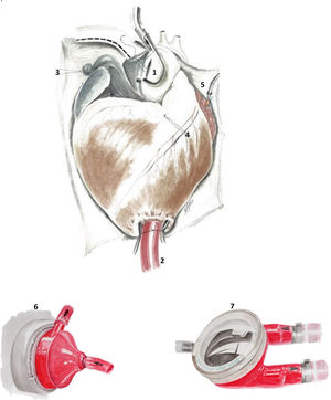 1) Sutura «en paracaídas» del injerto de PTFE a la aorta ascendente mediante pinzamiento aórtico lateral. 2) Cánula de drenaje en al ápex del ventrículo izquierdo mediante 2suturas circulares «en bolsa de tabaco». 3) Tracción lateral de aurícula derecha y tracción inferior (4) del tracto de salida del ventrículo derecho para exposición de aorta ascendente durante la anastomosis en la aorta ascendente. 5) Cánula en la aurícula izquierda para liberación de ME. 6) Bomba centrífuga Biomedicus®. 7) Bomba pulsátil Berlin Heart Excor®.